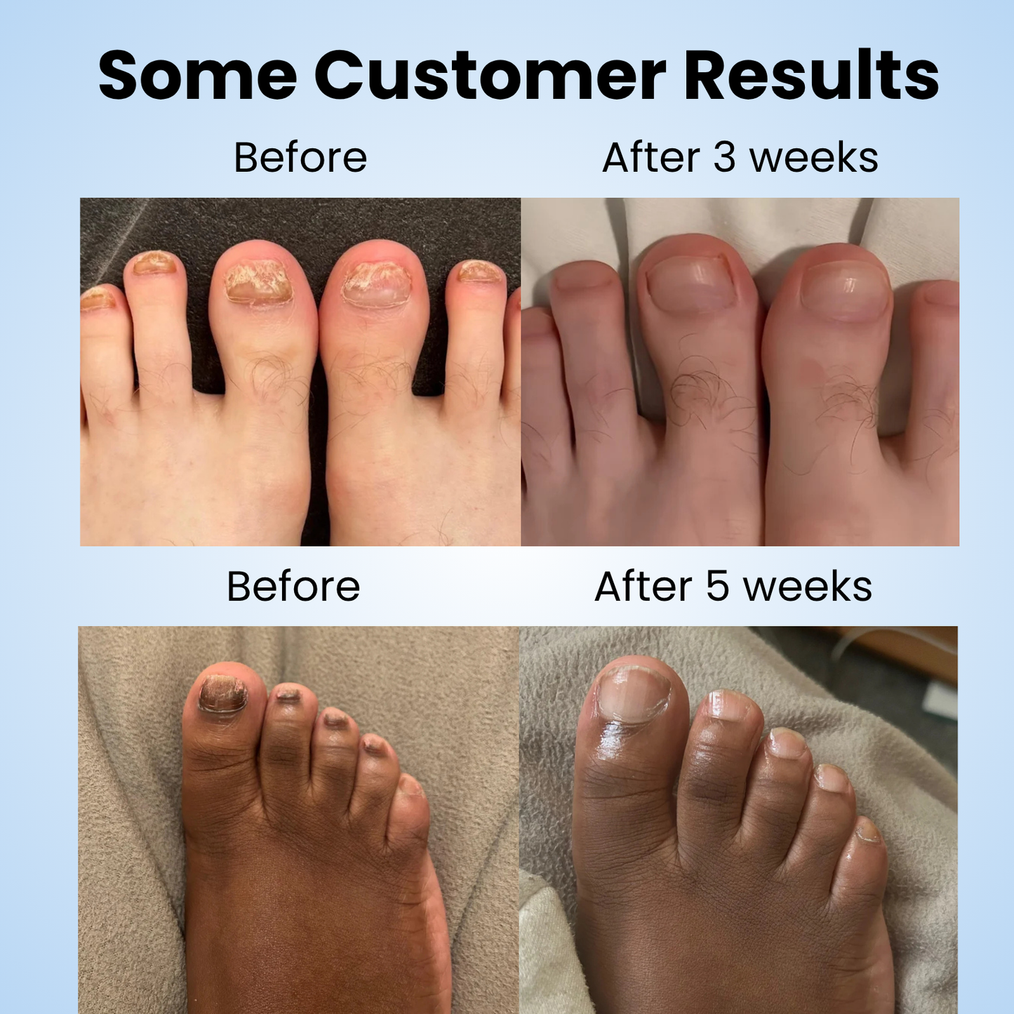 Glovoro™ - Fungal Nail Patches