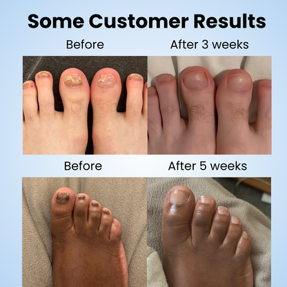 Glovoro™ - Fungal Nail Patches