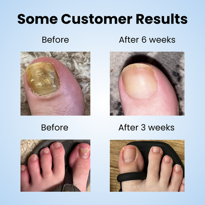 Glovoro™ - Fungal Nail Patches